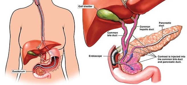 ERCP