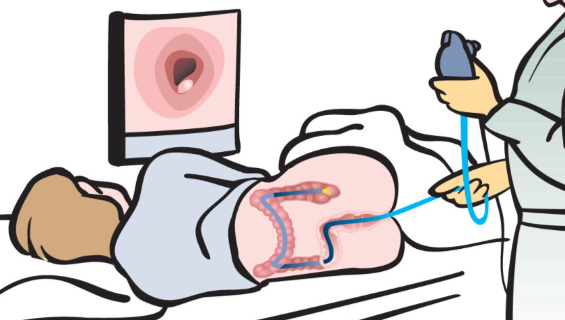 Flexible Sigmoidoscopy